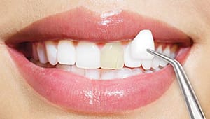 dental veneers